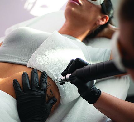 Tetoválás eltávolítás - Beauty Shape Tatabánya